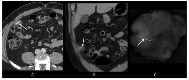 The figure consists of three images. The first two are axial and coronal images from intravenous contrast-enhanced computed tomography showing a wire grill-cleaning brush bristle in the omentum, surrounded by soft tissue stranding (inflammation). The third image is a specimen radiograph from omental resection that confirms complete foreign object removal.